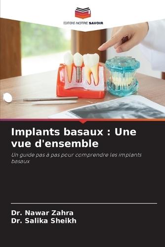 Implants basaux: Une vue d'ensemble
