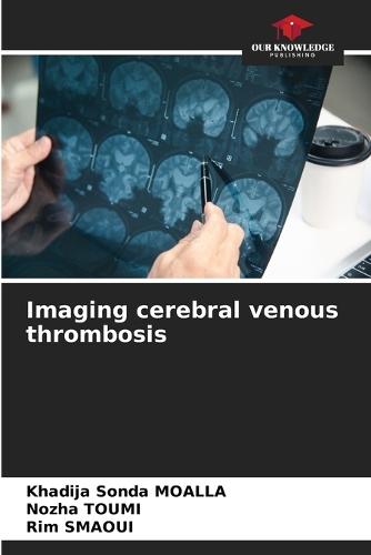 Imaging cerebral venous thrombosis