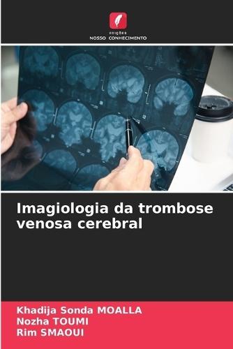Imagiologia da trombose venosa cerebral