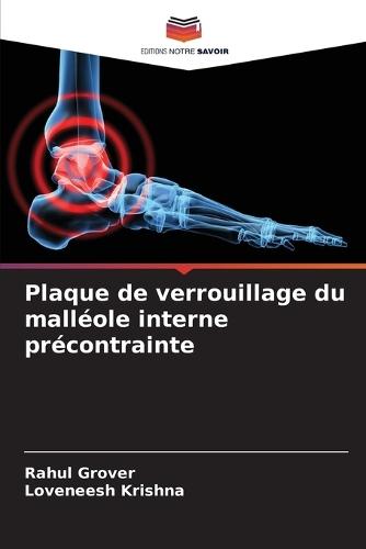 Plaque de verrouillage du malléole interne précontrainte