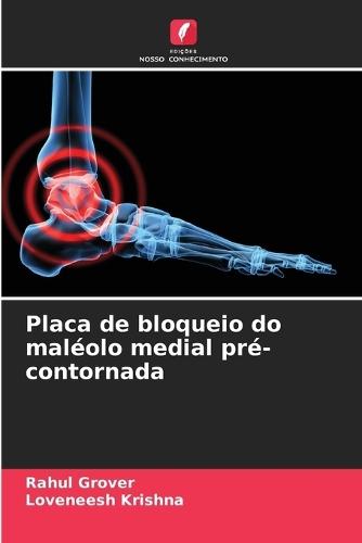 Placa de bloqueio do maléolo medial pré-contornada