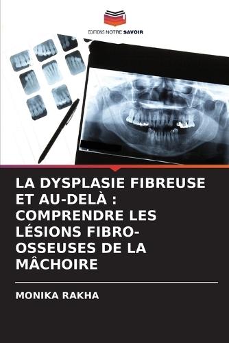 La Dysplasie Fibreuse Et Au-Delà: Comprendre Les Lésions Fibro-Osseuses de la Mâchoire