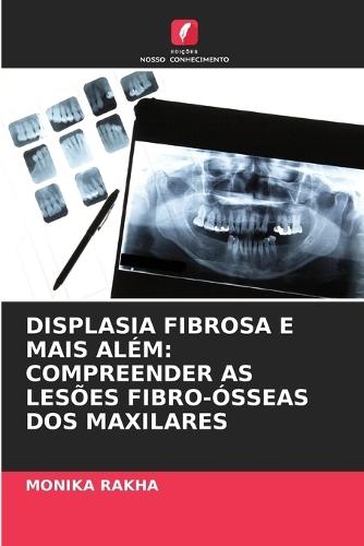 Displasia Fibrosa E Mais Além: Compreender as Lesões Fibro-Ósseas DOS Maxilares