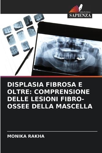 Displasia Fibrosa E Oltre: Comprensione Delle Lesioni Fibro-Ossee Della Mascella