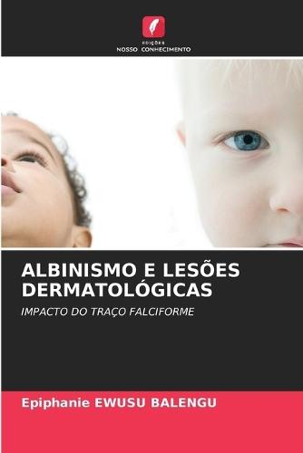 Albinismo E Lesões Dermatológicas