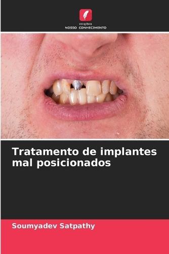 Tratamento de implantes mal posicionados