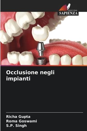 Occlusione negli impianti