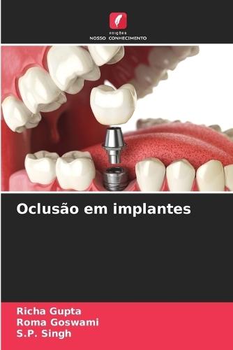 Oclusão em implantes