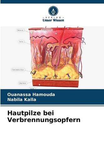 Hautpilze bei Verbrennungsopfern