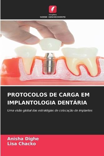 Protocolos de Carga Em Implantologia Dentária
