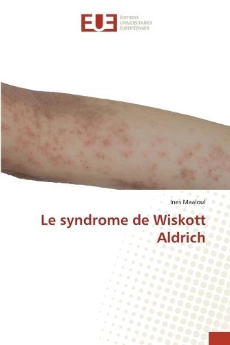 Le syndrome de Wiskott Aldrich