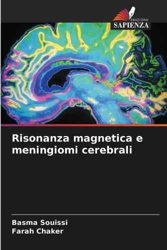 Risonanza magnetica e meningiomi cerebrali