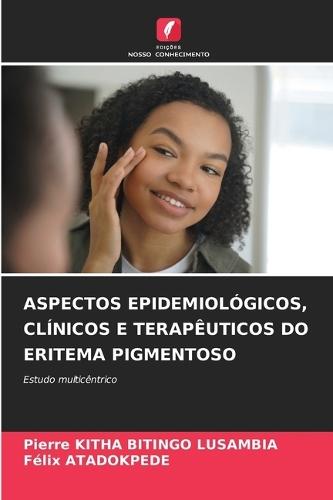 Aspectos Epidemiológicos, Clínicos E Terapêuticos Do Eritema Pigmentoso