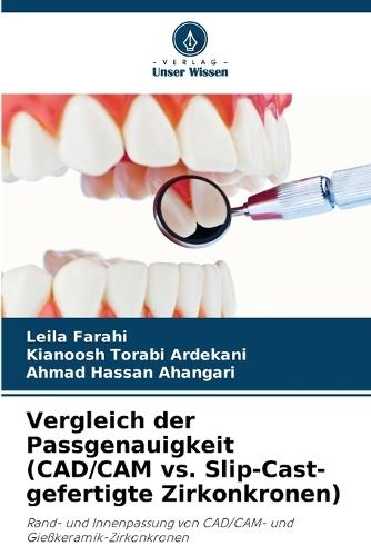 Vergleich der Passgenauigkeit (CAD/CAM vs. Slip-Cast-gefertigte Zirkonkronen)