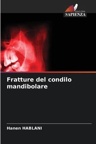Fratture del condilo mandibolare