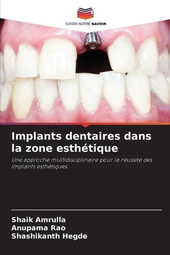 Implants dentaires dans la zone esthétique