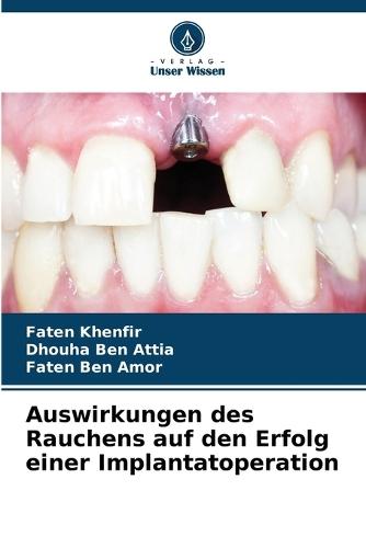 Auswirkungen des Rauchens auf den Erfolg einer Implantatoperation