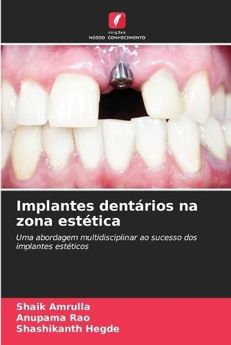 Implantes dentários na zona estética
