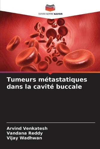 Tumeurs métastatiques dans la cavité buccale