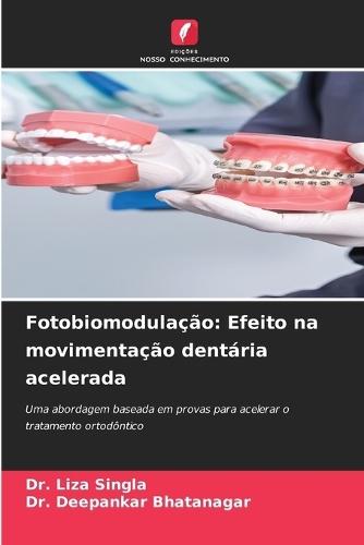 Fotobiomodulação: Efeito na movimentação dentária acelerada