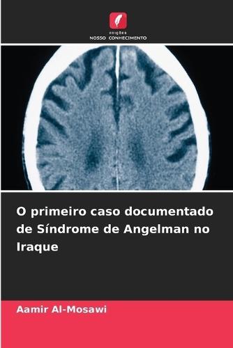 O primeiro caso documentado de Síndrome de Angelman no Iraque