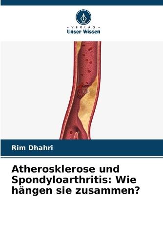 Atherosklerose und Spondyloarthritis: Wie hängen sie zusammen?