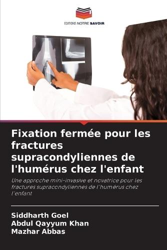 Fixation fermée pour les fractures supracondyliennes de l'humérus chez l'enfant