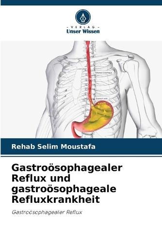Gastroösophagealer Reflux und gastroösophageale Refluxkrankheit