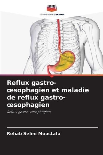 Reflux gastro-oesophagien et maladie de reflux gastro-oesophagien