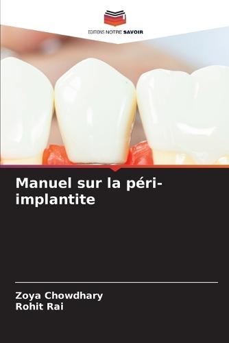 Manuel sur la péri-implantite