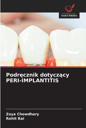 Podręcznik dotyczący PERI-IMPLANTITIS