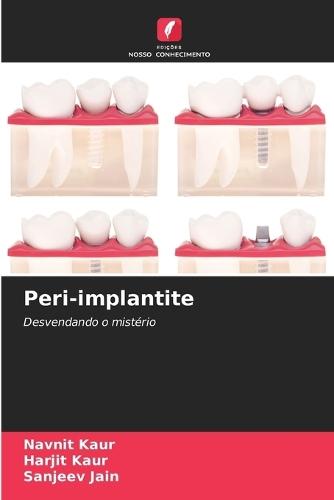 Peri-implantite