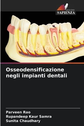 Osseodensificazione negli impianti dentali