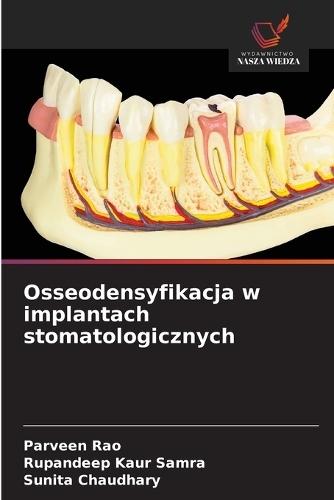 Osseodensyfikacja w implantach stomatologicznych