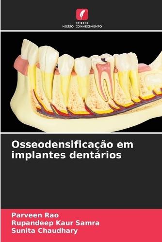 Osseodensificação em implantes dentários