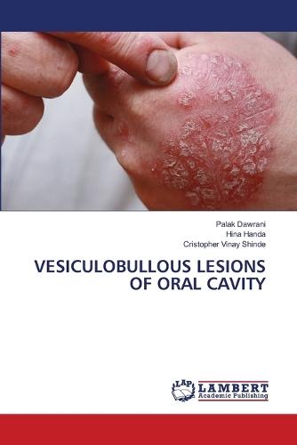 Vesiculobullous Lesions of Oral Cavity