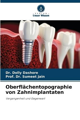 Oberflächentopographie von Zahnimplantaten