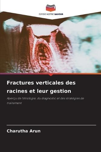 Fractures verticales des racines et leur gestion
