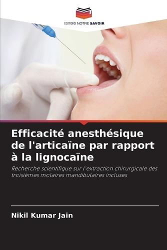 Efficacité anesthésique de l'articaïne par rapport à la lignocaïne
