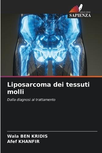 Liposarcoma dei tessuti molli
