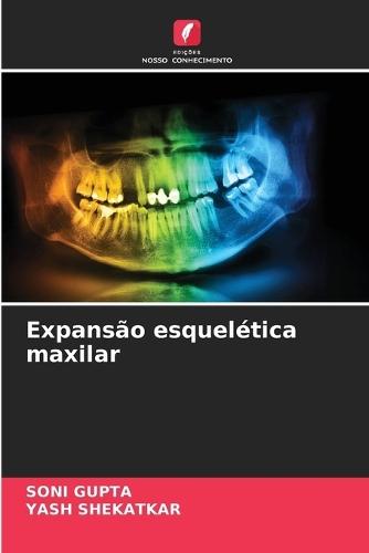 Expansão esquelética maxilar