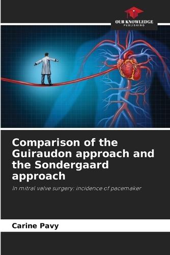 Comparison of the Guiraudon approach and the Sondergaard approach
