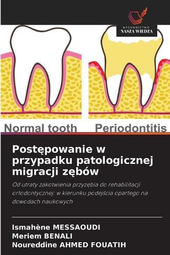 Postępowanie w przypadku patologicznej migracji zębów