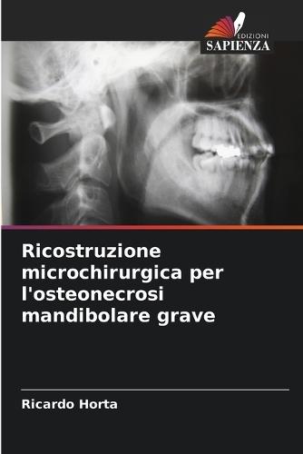 Ricostruzione microchirurgica per l'osteonecrosi mandibolare grave