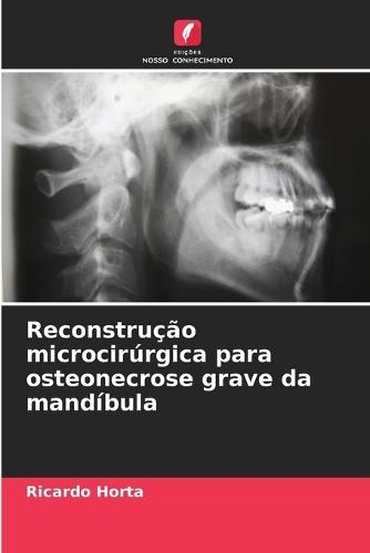 Reconstrução microcirúrgica para osteonecrose grave da mandíbula