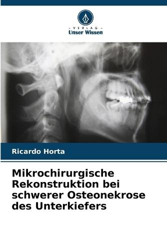Mikrochirurgische Rekonstruktion bei schwerer Osteonekrose des Unterkiefers