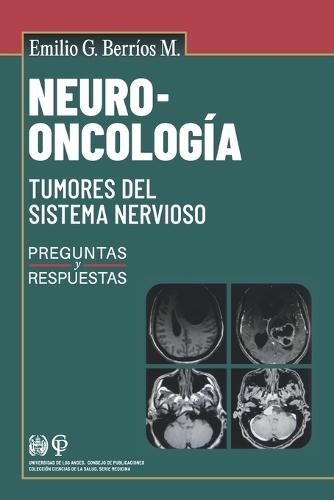 Neuro-oncología: Tumores del sistema nervioso