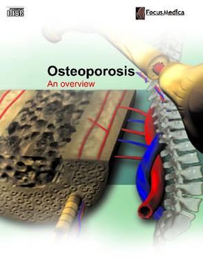 Osteoporosis: An Overview