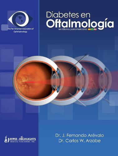 Diabetes en Oftalmología