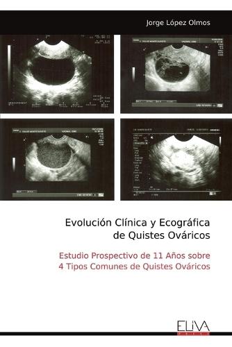 Evolución Clínica y Ecográfica de Quistes Ováricos: Estudio Prospectivo de 11 Años sobre 4 Tipos Comunes de Quistes Ováricos